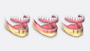 Apr 12, 2021 · recovering addicts. Full Arch Implant Surgical And Restorative Considerations Elegant Lab