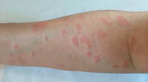 Non itchy hives on arms and legs. Red Circle On The Skin But Not Ringworm Other Causes
