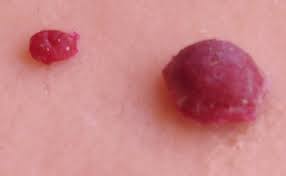 Cherry angioma removal | if you've noticed a circular, bright red, small shape on your body, you may be dealing with a cherry angioma. Cherry Angiomas Pictures Symptoms Causes Treatment Removal Hubpages