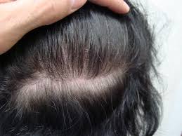 La chute de cheveux peut rapidement devenir un véritable handicap, surtout quand on n'a pas encore atteint la cinquantaine. Raie Trop Marquee Chez La Femme Des Solutions Existent The Clinic