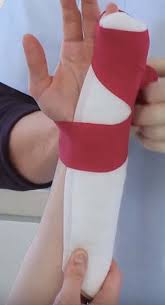 Image result for Radial Gutter Cast