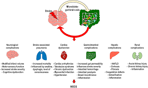 Brain edema — swelling of the brain after a stroke. Frontiers Gut Microbiota In Acute Ischemic Stroke From Pathophysiology To Therapeutic Implications Neurology