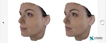 Nasenkorrektur Fakten Kosten Und Arzte Zur Rhinoplastik Hockernase Asthetisch Korrigieren