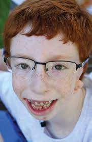 thankful for crouzon syndrome