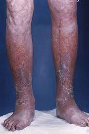 If untreated, it can cause serious health problems. Skin Manifestations Of Thyroid Disorders A Review Dermatology Advisor
