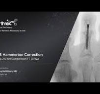 MIS Hammertoe Correction Using 2.5 mm Compression FT Screws ...