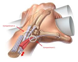 Image result for Intersection Syndrome