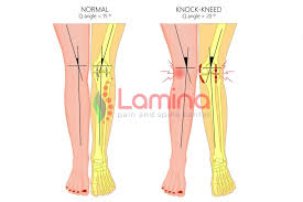 Check spelling or type a new query. Bentuk Kaki X Pada Orang Dewasa Penyebab Dan Dampaknya Apa Klinik Patella