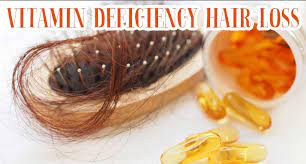 Believe it or not, nutrient deficiencies can lead to hair loss in women, which is why adequate nutrition is so important to maintain luscious locks. Does Vitamin Deficiency Entail Hair Loss How To Deal With It Lewigs