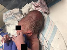 Image result for Cephalhematoma