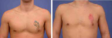 William reno iii and paul talbot of hattiesburg, ms by calling (601) 296. Dealing With Tattoos In Plastic Surgery Tattoo Removal Sciencedirect