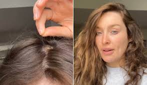 Roz Purcell Shares 'Reassuring' Alopecia Update After Second Round Of  Injections