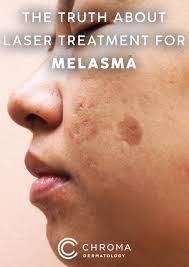 Image result for Melasma