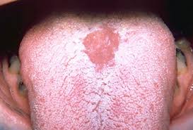 Maybe you would like to learn more about one of these? Why Does A White Coating Appear On The Tongue Causes Of White Plaque On The Tongue And Its Treatment