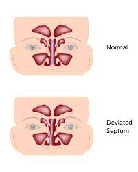 O interventie clasica pentru i deviatie de sept se poate face elegand si bine. Totul Despre Deviatia De Sept Cauze Simptome Si Tratare