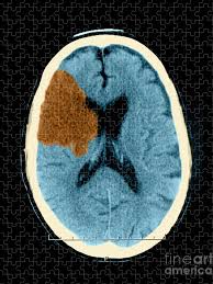 13 new horizons now exist for addressing sleep disorders, which often develop after acquired brain injury. Ct Of Stroke Puzzle For Sale By Medical Body Scans