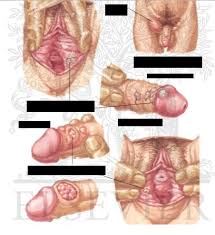 Image result for genital warts