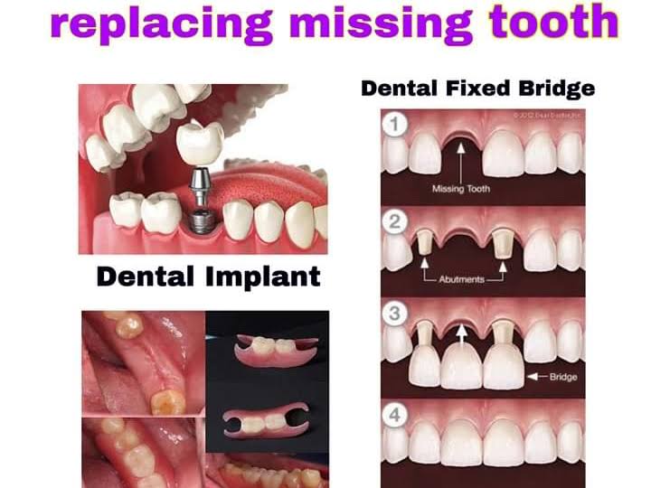 Fixed Crown And Bridge product image