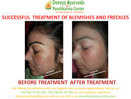 Im a male of 34 years of age & suffering from melasma for past three four months and it is on both the cheeks and partly on nose as well like a butterfly shape.im taking treatment with organic. Remove Pimples And Pigmentation With Ayurveda How To Remove Pimples How To Reduce Pimples Pimples