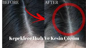 2 Yikamada Kepekten Kurtulma Hizli Ve Kesin Cozum Youtube