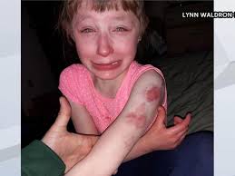 10-year-old girl with special needs bitten by student