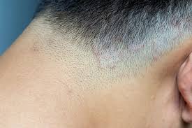 Image result for Tinea Capitis