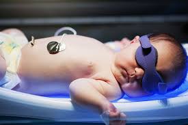 jaundice in newborns causes symptoms and treatment