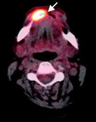 Image result for spinocellular carcinoma of the oral cavity