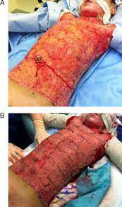 Burn eschar may have different appearances and thicknesses, and may behave in different ways as a function of etiology and time since injury, as well as topical and other treatment modalities. Initial Assessment And Management Of Thermal Burn Injuries In Children American Academy Of Pediatrics
