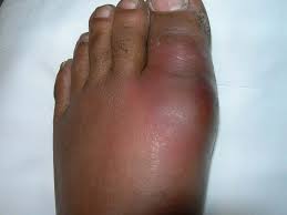 Image result for gout symptoms toe