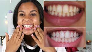 We did not find results for: Best At Home Teeth Whitening For Sensitive Teeth Giveaway Tamara Ahmed Youtube