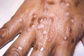 Image result for Smallpox