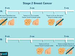 Getting the right treatment for the specific tumor type can have an impact on a patient&#x27;s survival. Stage 2 Breast Cancer Diagnosis Treatment Survival