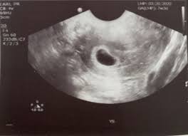 The gestational age is calculated by the number of weeks since the last menstrual period; 7 Week Ultrasound No Heartbeat Babycenter