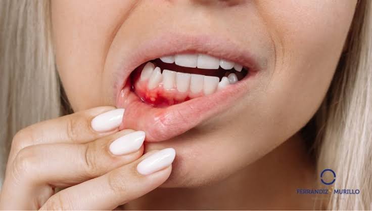 Gingivitis y Cuidado de Encías
