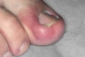 Maybe you would like to learn more about one of these? Ingrown Toenail Nhs
