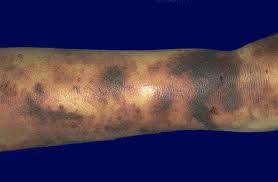 Image result for Pigment stains on the shin