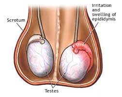 Có nhiều nguyên nhân gây đau sưng tinh hoàn