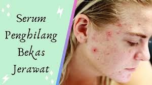 Melansir mirror, lidah buaya memiliki kandungan antiperadangan dan antibakteri. 10 Rekomendasi Serum Penghilang Bekas Jerawat Update Tahun 2021