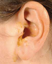 Otitis Externa Zugig Und Konsequent Behandeln Springerlink