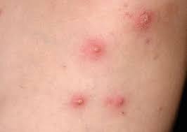 Mrsa stands for methicillin resistant staphylococcus aureus, a type of bacteria that has become resistant to several types of antibiotics which are being used to treat ordinary staph infections. Kutane Infektionen Durch Staphylokokken Und Streptokokken Springerlink