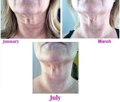 Sagging Neck Skin Update See New Before And After Sagging Neck Skin Sagging Face Neck Wrinkles