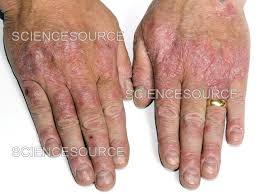 Image result for psoriasis