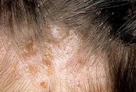 Hair mites are most commonly found on a person's eyelashes and eyebrows, and don't usually cause any symptoms. Lice How To Tell If You Have Them