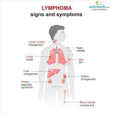 Many of them are sporadic meaning spontaneous without any cause few are genetic. Lymphoma Causes Symptoms And Treatment Netmeds