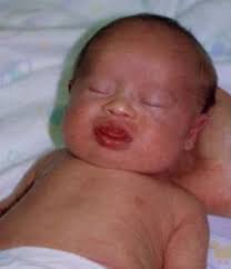 Monolids (epicanthal folds) are eyelids without creases. Which Ocular Findings Are Characteristic Of Down Syndrome