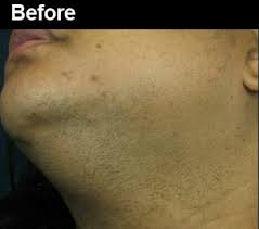 After the procedure you might notice redness and swelling for the first few hours after laser hair removal. Laser Hair Removal Before And After Pictures Wifh
