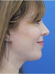 Preservation Rhinoplasty 6721