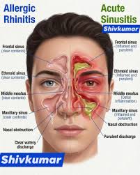 Image result for Allergic Rhinitis