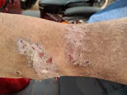 Image result for scabies transmission